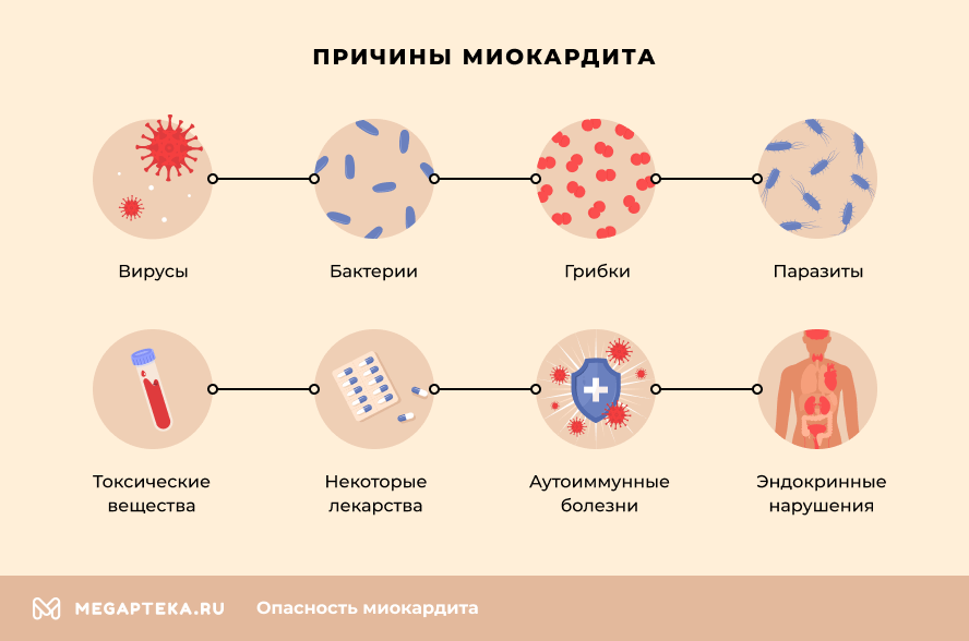 Схема лечения миокардита