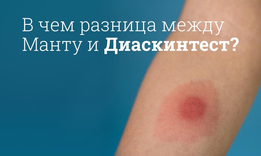 В чем разница между Манту и Диаскинтест?